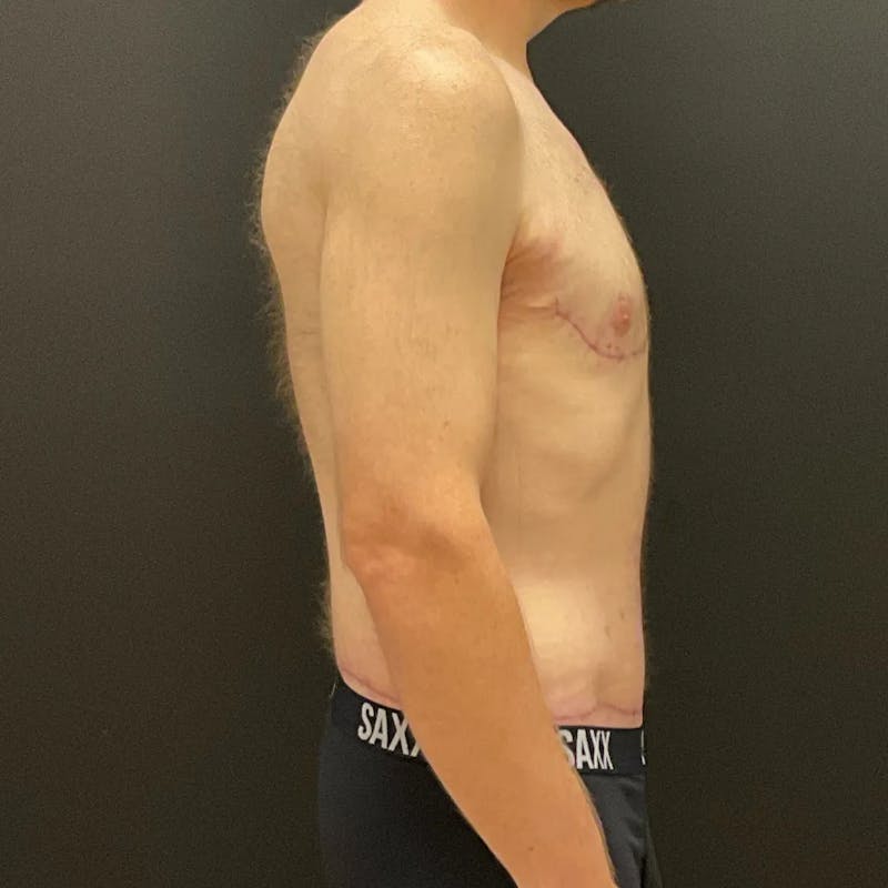 Body Lift Before & After Gallery - Patient 393208 - Image 4