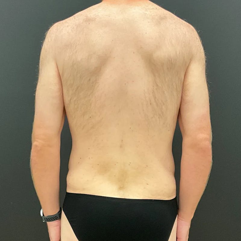 Body Lift Before & After Gallery - Patient 393208 - Image 5