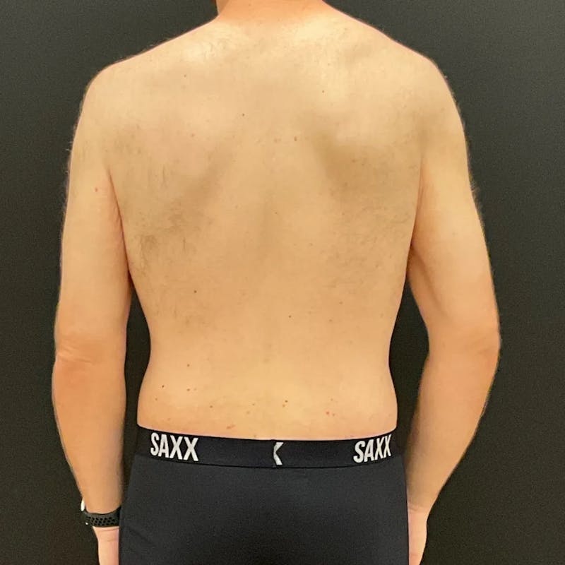 Body Lift Before & After Gallery - Patient 393208 - Image 6