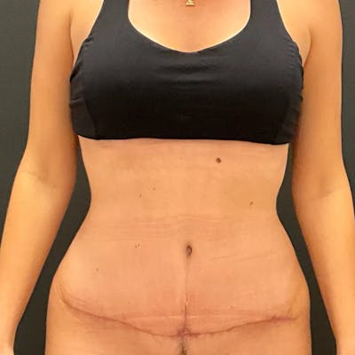Tummy Tuck Before & After Gallery - Patient 367136 - Image 2