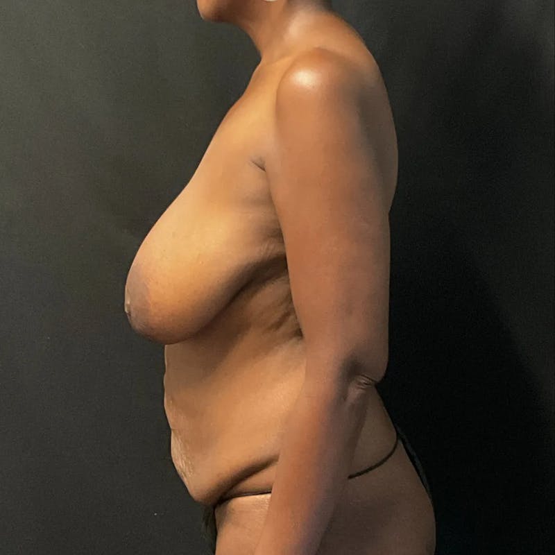 Tummy Tuck Before & After Gallery - Patient 377421 - Image 3