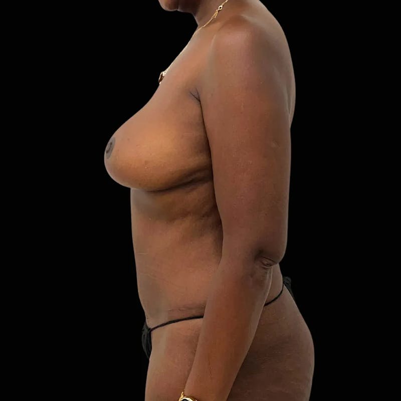 Tummy Tuck Before & After Gallery - Patient 377421 - Image 4