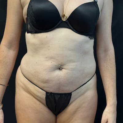 Tummy Tuck Before & After Gallery - Patient 254799 - Image 1