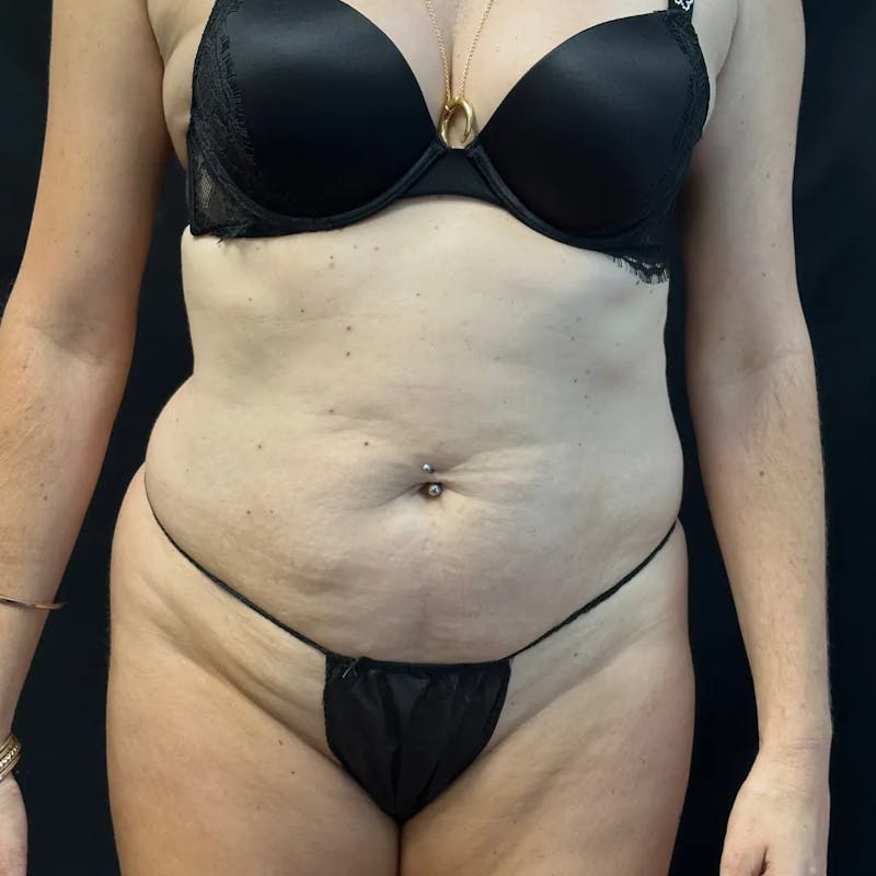 Tummy Tuck Before & After Gallery - Patient 254799 - Image 1