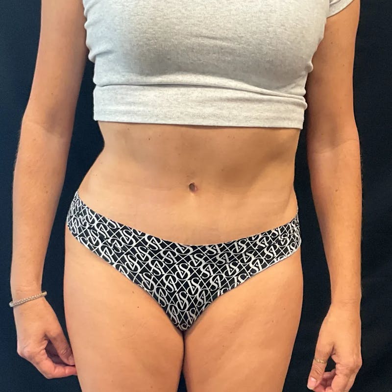 Tummy Tuck Before & After Gallery - Patient 254799 - Image 2