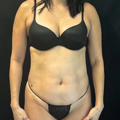 Tummy Tuck Before & After Gallery - Patient 223526 - Image 1