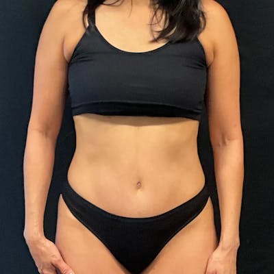 Tummy Tuck Before & After Gallery - Patient 223526 - Image 2