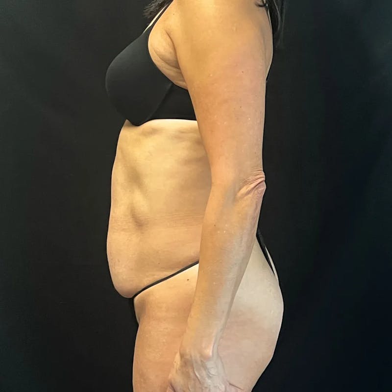 Tummy Tuck Before & After Gallery - Patient 223526 - Image 3