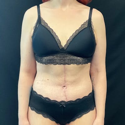 Tummy Tuck Before & After Gallery - Patient 170241 - Image 2