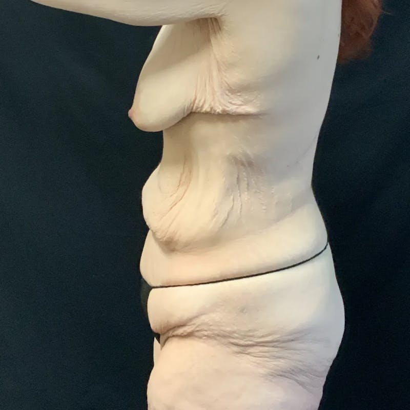 Tummy Tuck Before & After Gallery - Patient 170241 - Image 3