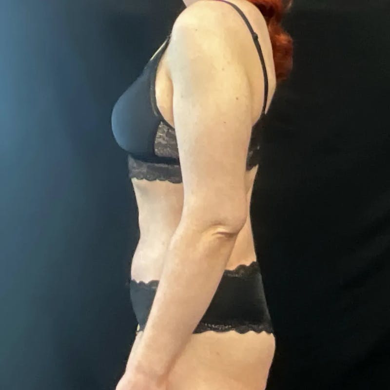 Tummy Tuck Before & After Gallery - Patient 170241 - Image 4