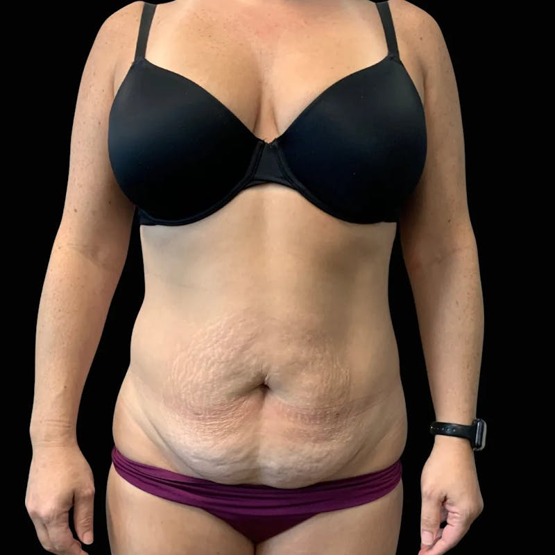 Tummy Tuck Before & After Gallery - Patient 394222 - Image 1