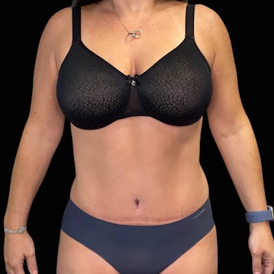 Tummy Tuck Before & After Gallery - Patient 394222 - Image 2