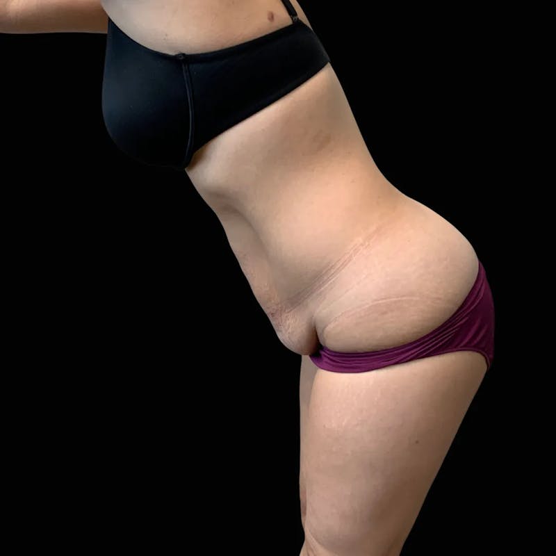 Tummy Tuck Before & After Gallery - Patient 394222 - Image 3