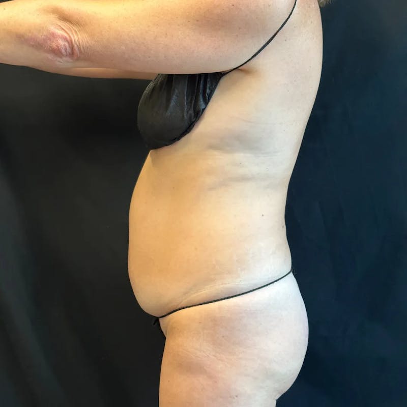 Tummy Tuck Before & After Gallery - Patient 429473 - Image 3