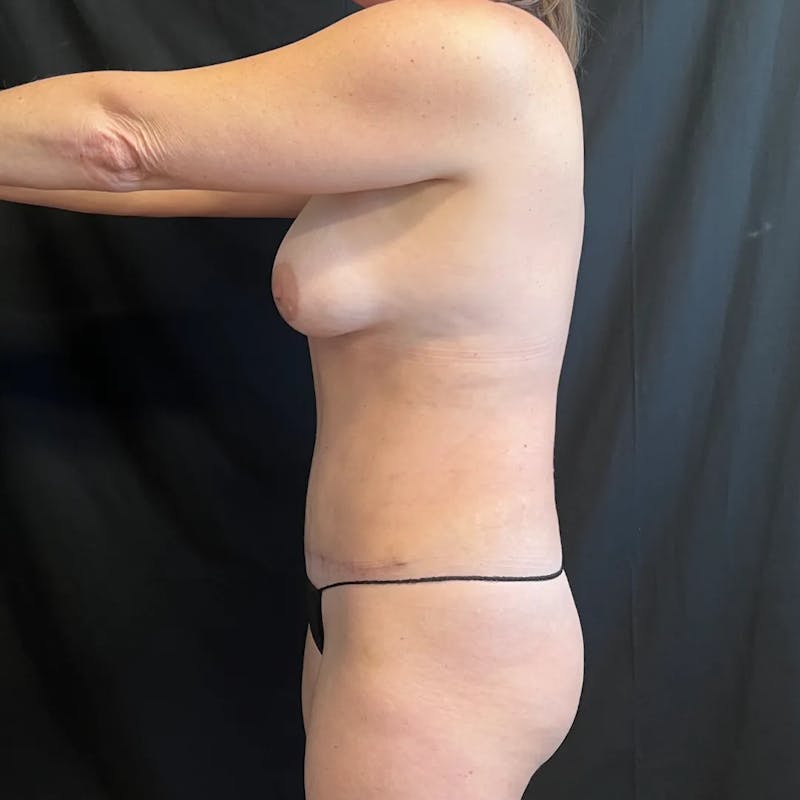 Tummy Tuck Before & After Gallery - Patient 429473 - Image 4