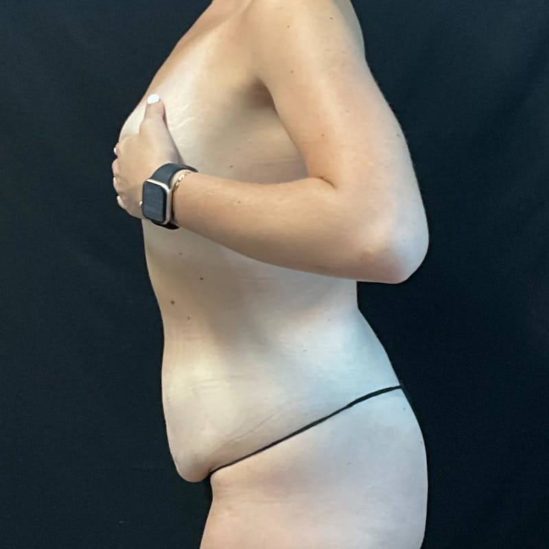 Tummy Tuck Before & After Gallery - Patient 220980 - Image 3