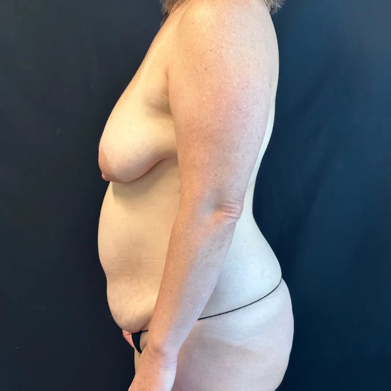 Tummy Tuck Before & After Gallery - Patient 419797 - Image 3