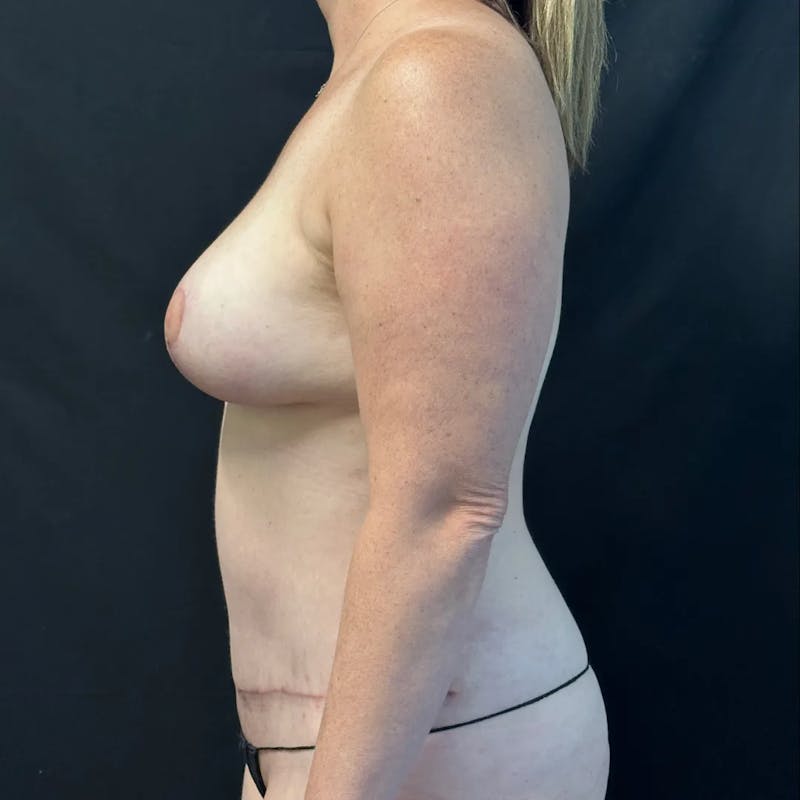 Tummy Tuck Before & After Gallery - Patient 419797 - Image 4