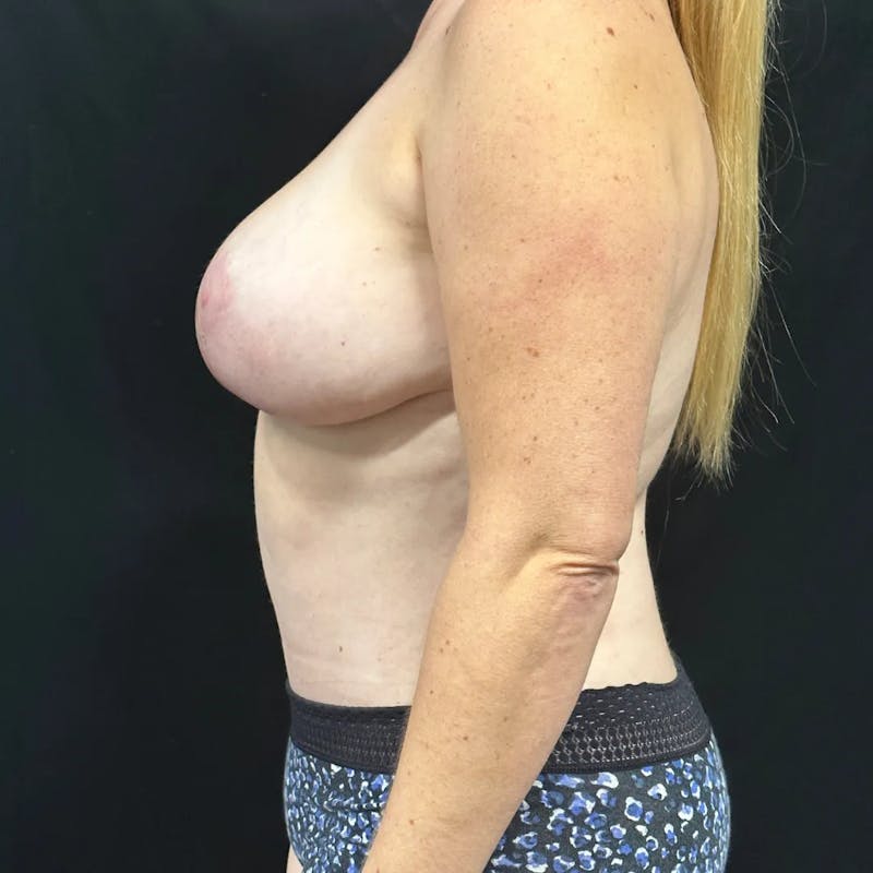 Tummy Tuck Before & After Gallery - Patient 817969 - Image 4