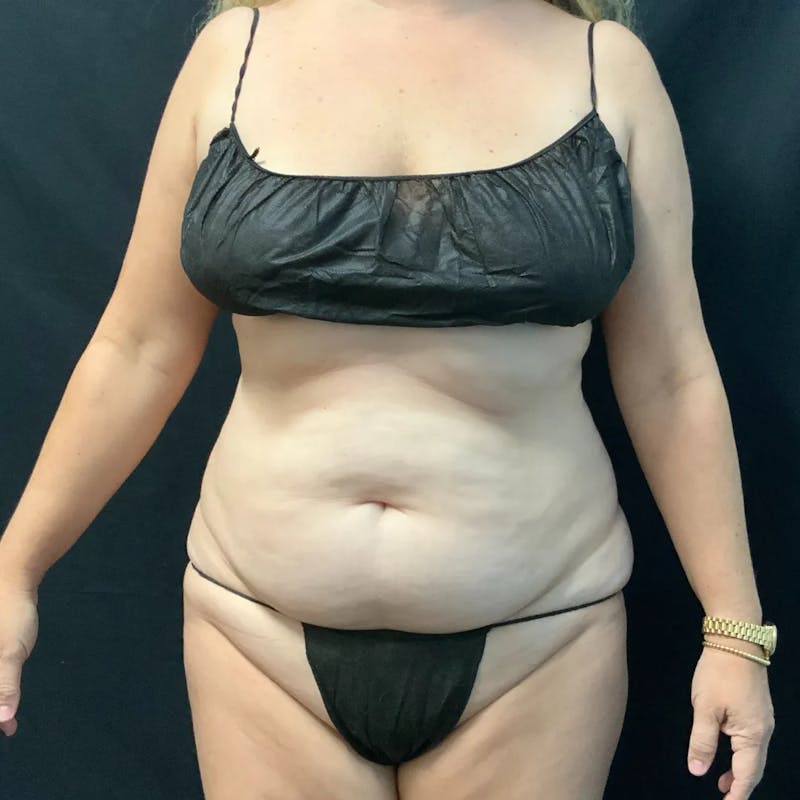 Tummy Tuck Before & After Gallery - Patient 280562 - Image 1