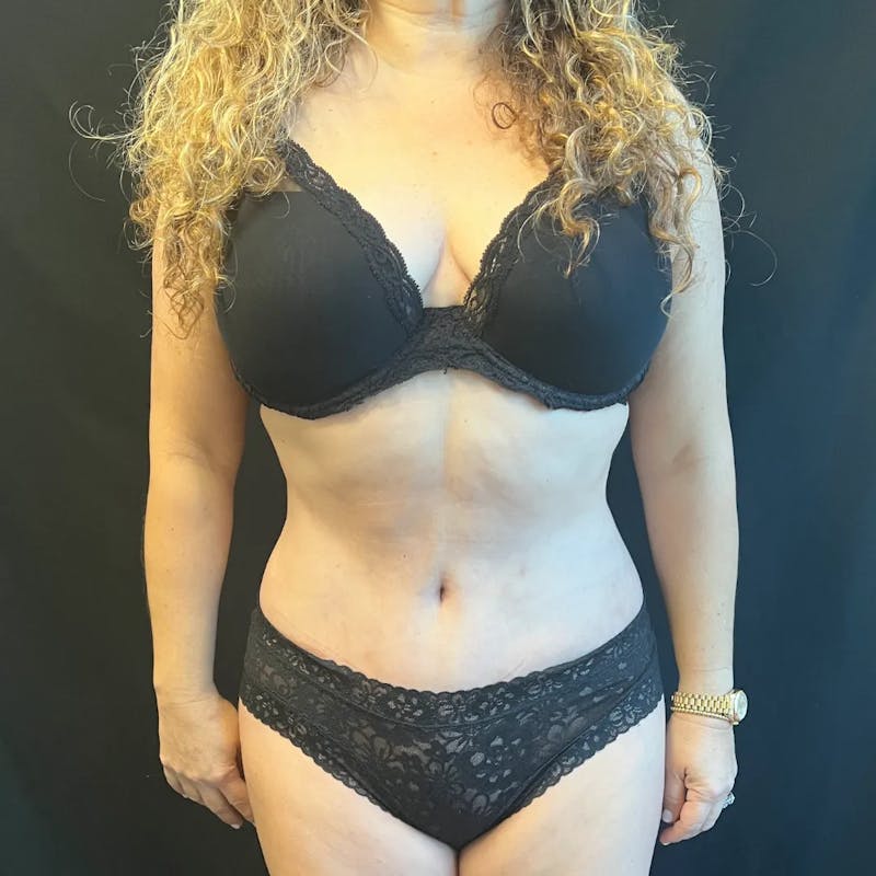 Tummy Tuck Before & After Gallery - Patient 280562 - Image 2