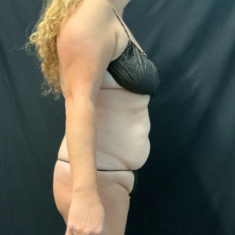 Tummy Tuck Before & After Gallery - Patient 280562 - Image 3