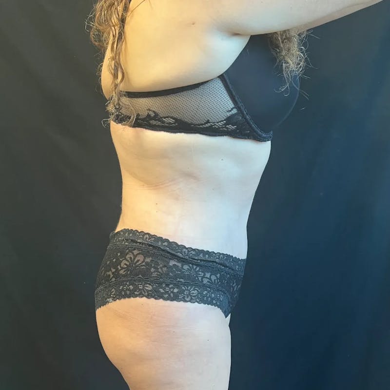 Tummy Tuck Before & After Gallery - Patient 280562 - Image 4