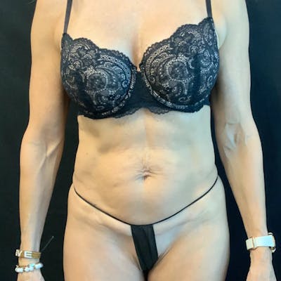 Tummy Tuck Before & After Gallery - Patient 403559 - Image 1