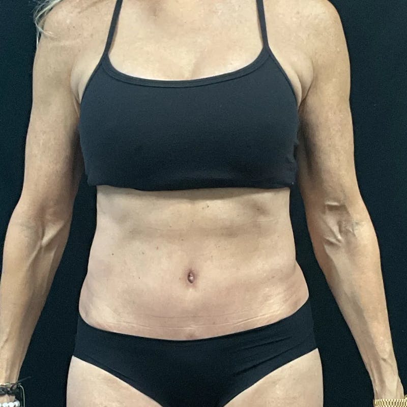 Tummy Tuck Before & After Gallery - Patient 403559 - Image 2