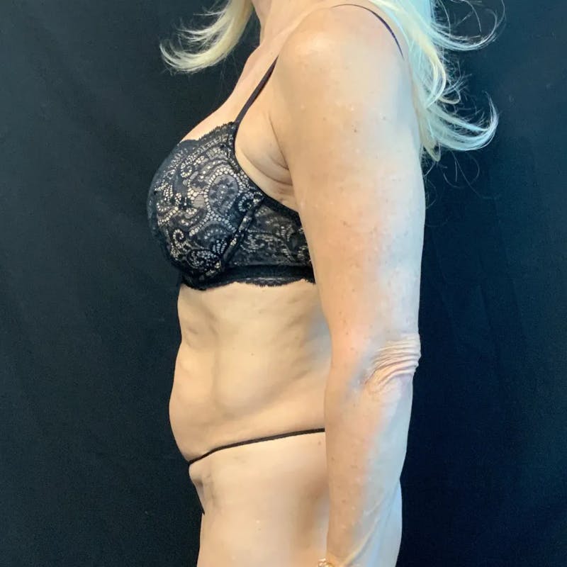Tummy Tuck Before & After Gallery - Patient 403559 - Image 3