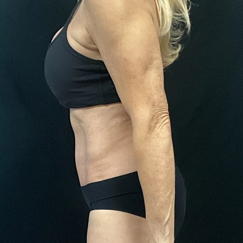 Tummy Tuck Before & After Gallery - Patient 403559 - Image 4