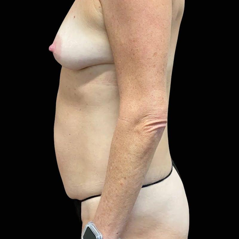 Tummy Tuck Before & After Gallery - Patient 363186 - Image 3
