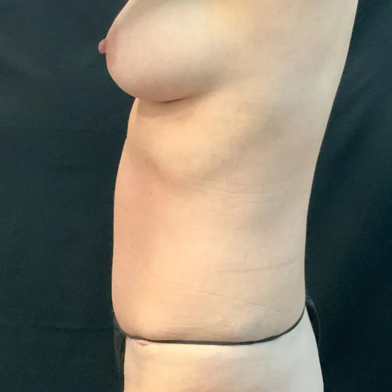 Tummy Tuck Before & After Gallery - Patient 363186 - Image 4