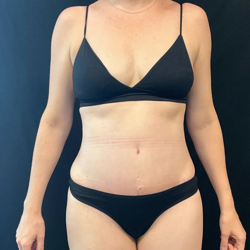 Tummy Tuck Before & After Gallery - Patient 963951 - Image 2