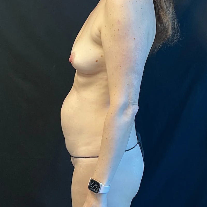 Tummy Tuck Before & After Gallery - Patient 963951 - Image 3