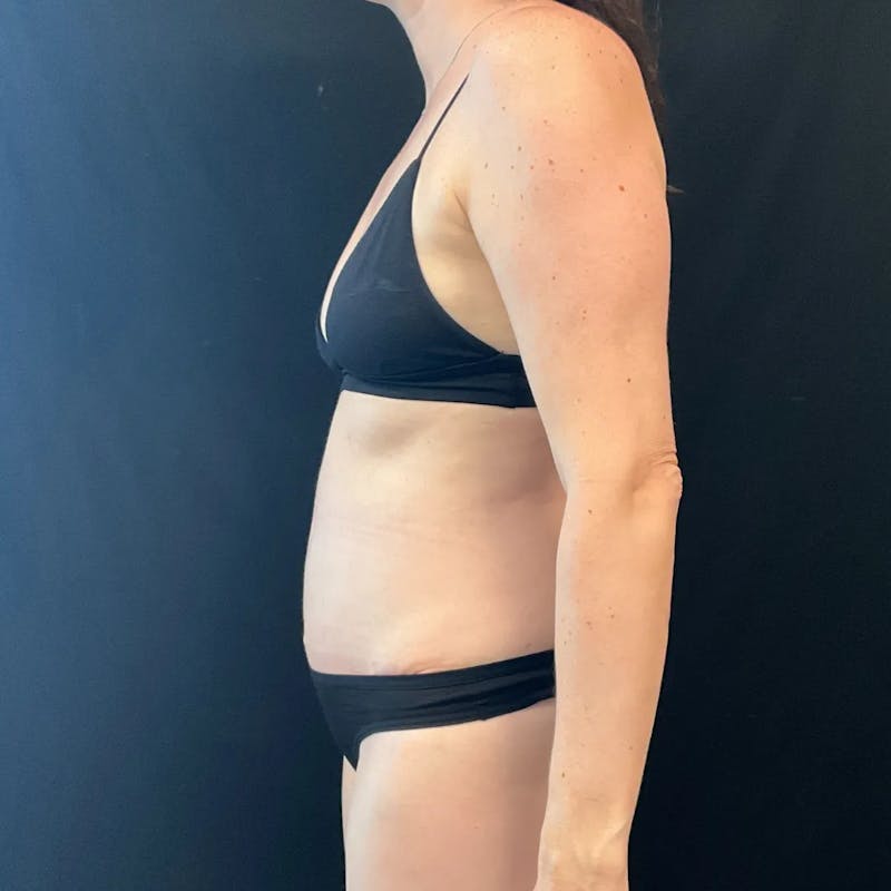 Tummy Tuck Before & After Gallery - Patient 963951 - Image 4