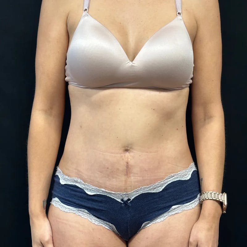 Tummy Tuck Before & After Gallery - Patient 347097 - Image 2
