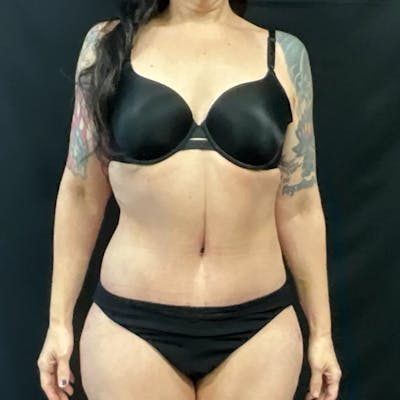Tummy Tuck Before & After Gallery - Patient 138897 - Image 2