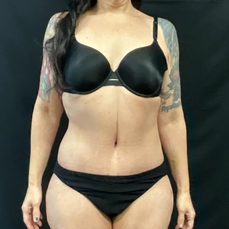 Tummy Tuck Before & After Gallery - Patient 138897 - Image 2