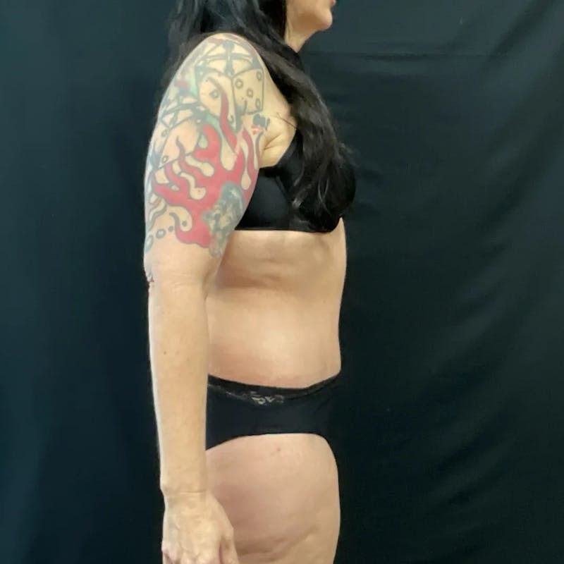 Tummy Tuck Before & After Gallery - Patient 138897 - Image 4