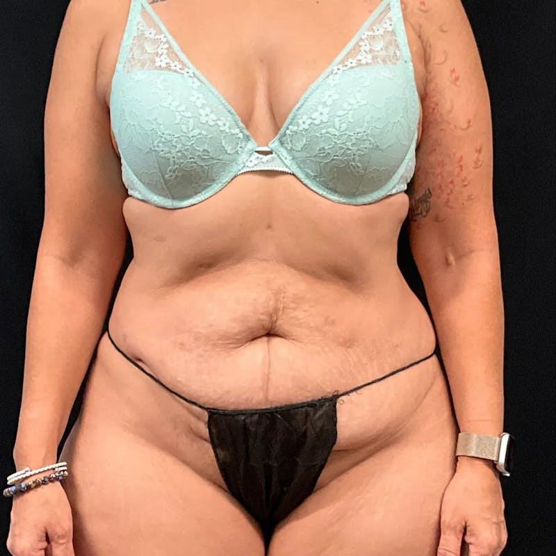 Tummy Tuck Before & After Gallery - Patient 369274 - Image 1