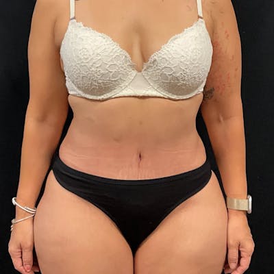 Tummy Tuck Before & After Gallery - Patient 369274 - Image 2