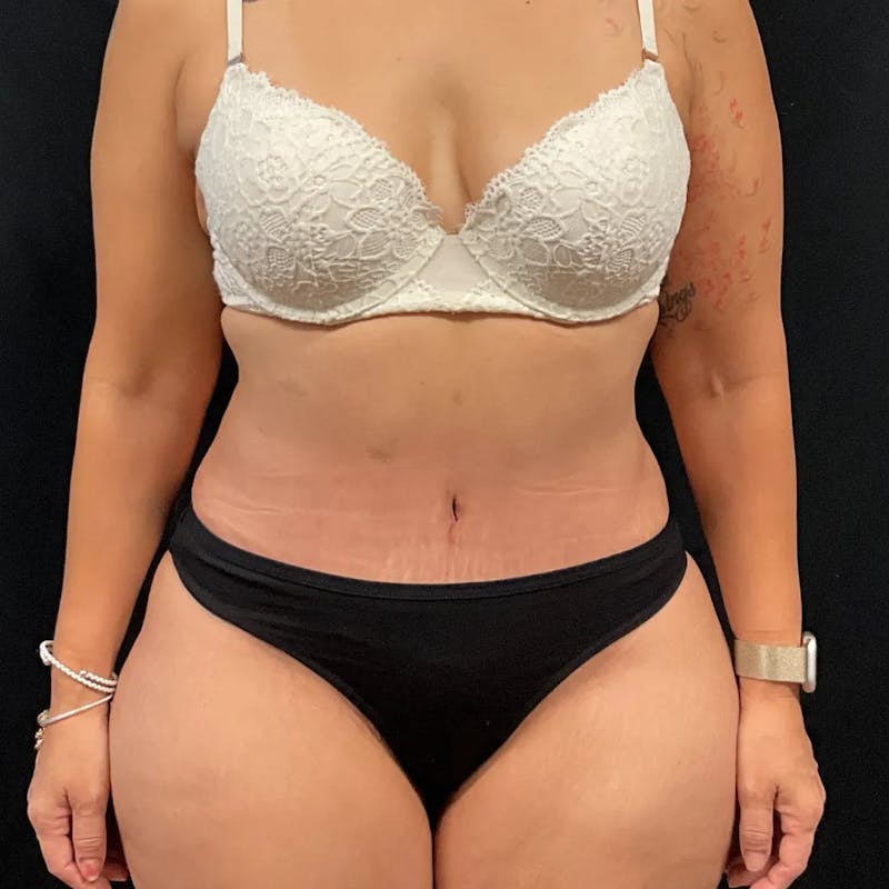 Tummy Tuck Before & After Gallery - Patient 369274 - Image 2