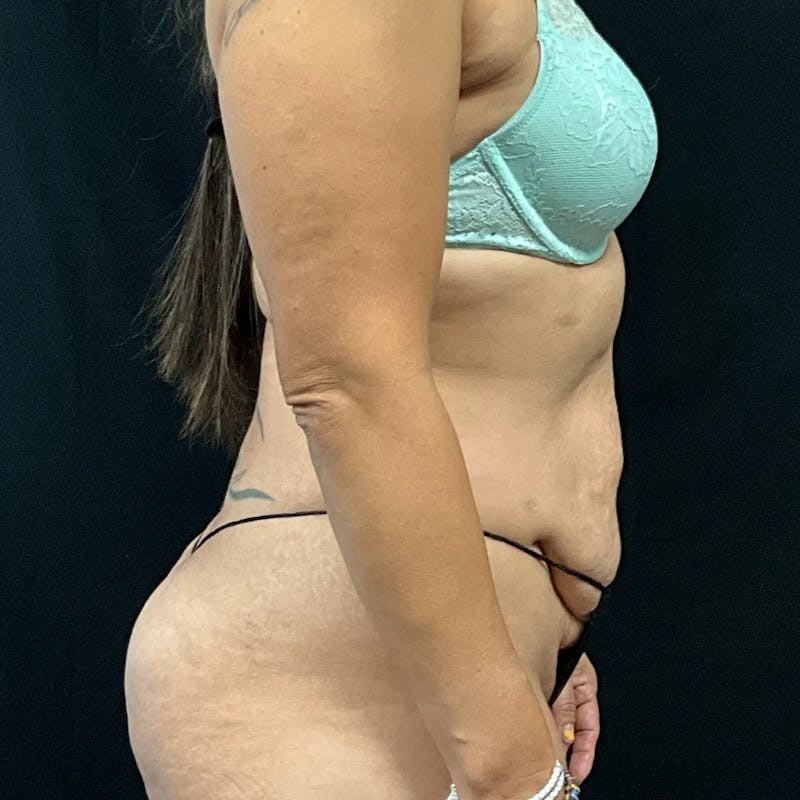 Tummy Tuck Before & After Gallery - Patient 369274 - Image 3