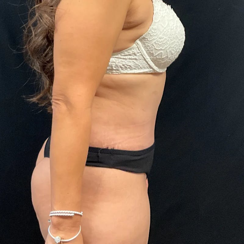 Tummy Tuck Before & After Gallery - Patient 369274 - Image 4