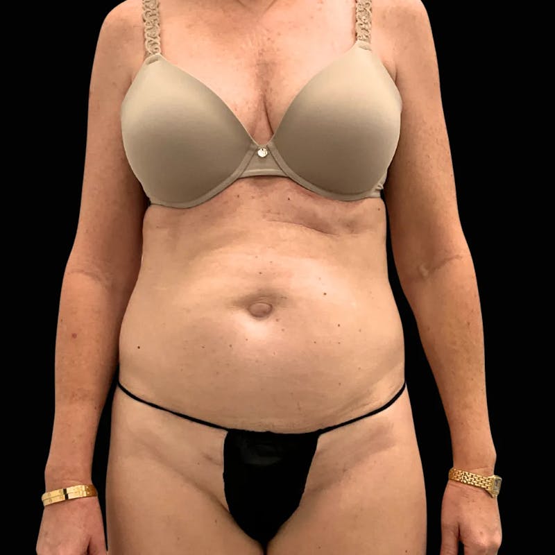 Tummy Tuck Before & After Gallery - Patient 193705 - Image 1