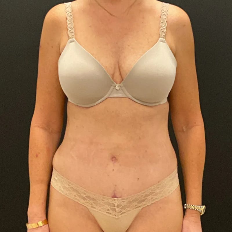 Tummy Tuck Before & After Gallery - Patient 193705 - Image 2