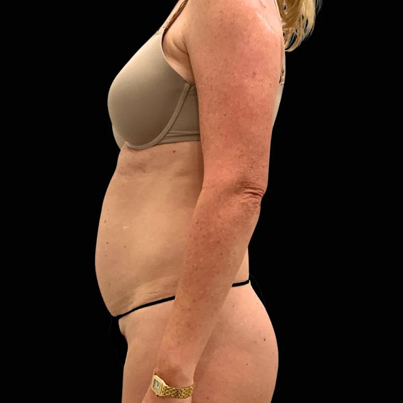 Tummy Tuck Before & After Gallery - Patient 193705 - Image 3