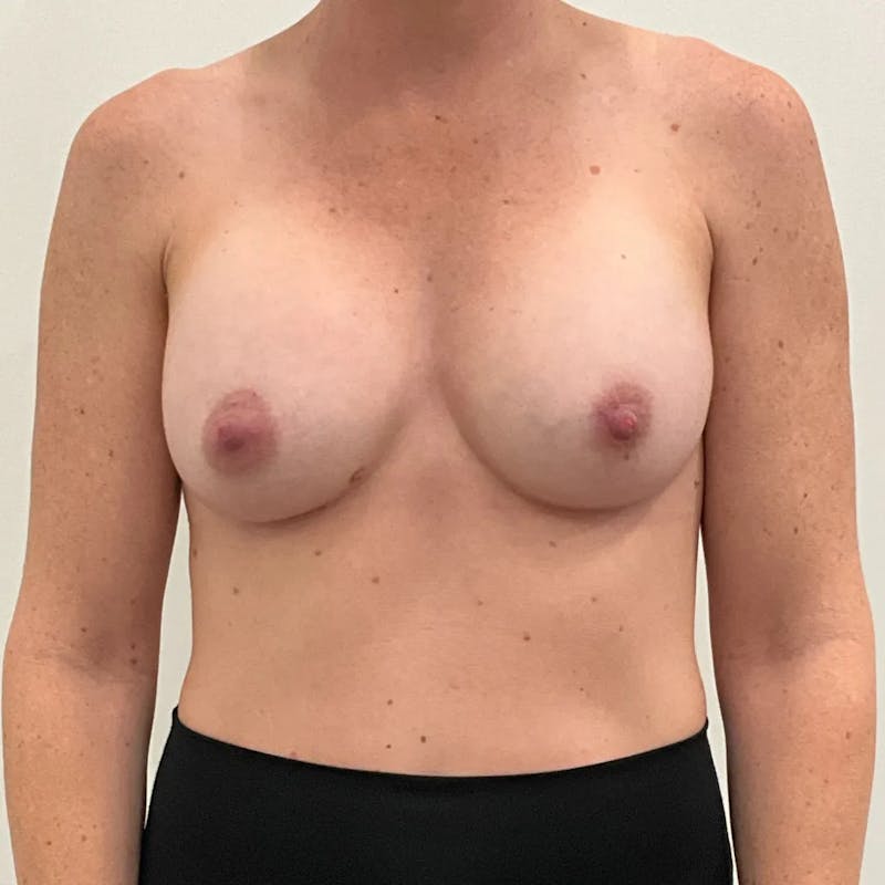 Breast Augmentation Before & After Gallery - Patient 340433 - Image 2